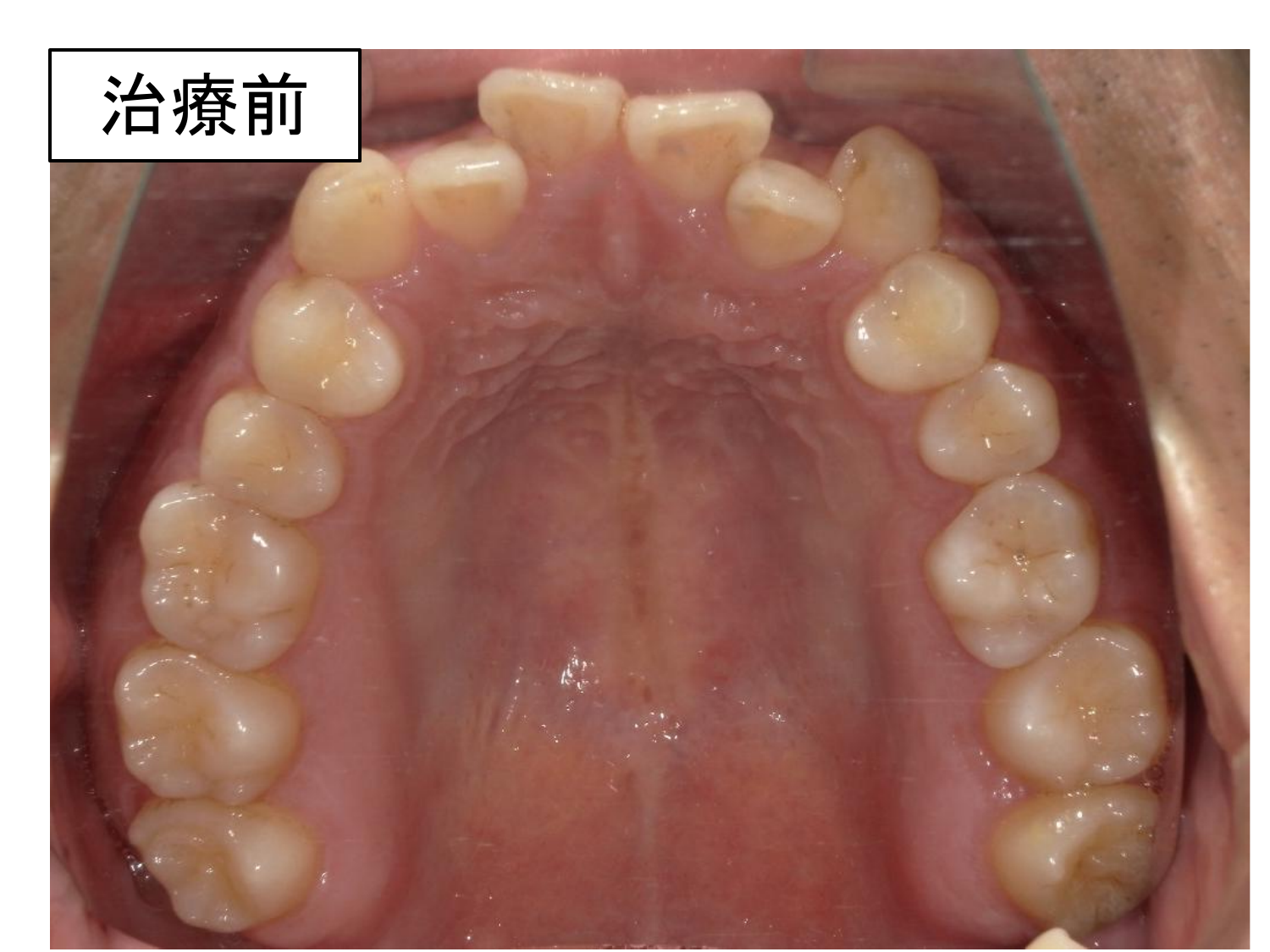 治療前の口腔内写真。前歯部叢生を認める。